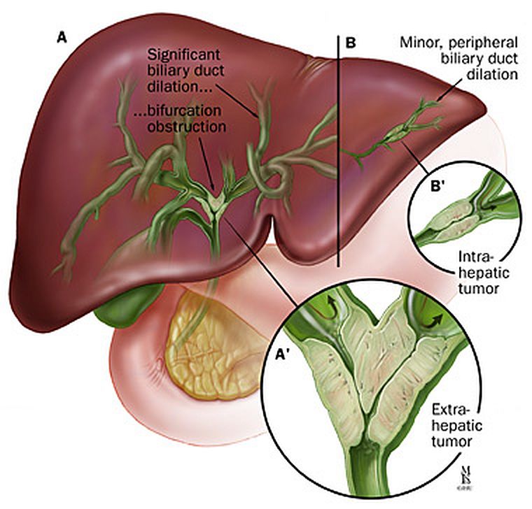 bile duct cancer within the walls